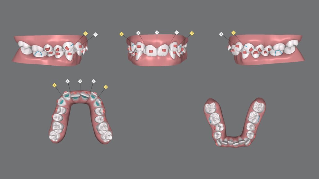 Invisalign Personalized Plan: una nuova funzionalità time-saver per medico e paziente