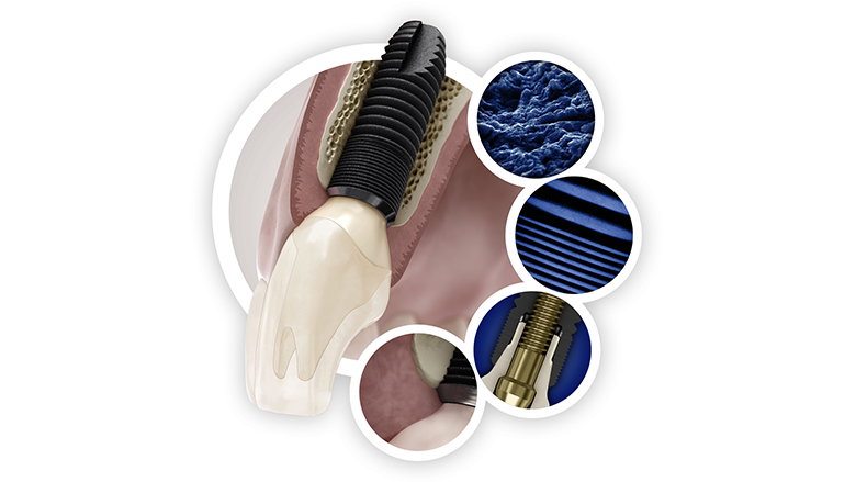 Fig 1: Astra Tech Implant System  BioManagement Complex