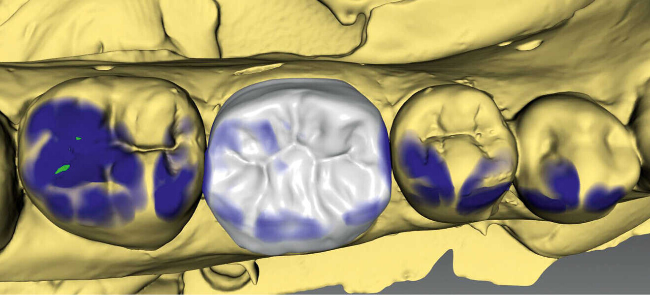 Figs. 3a & 3b. Diseño de la corona con el software (inLab) y prueba de la corona antes de la cocción de cristalización (IPS e.max CAD).