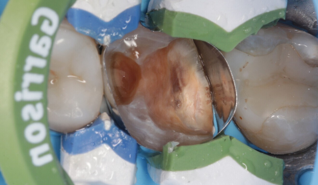Fig. 9: Insufficient fit of the distal matrix. (Image: Kuraray Noritake Dental)