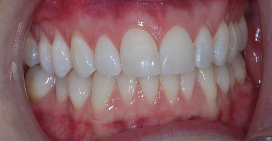 Fig. 19: Post treatment retracted