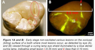 GreenMark to develop technology for early caries detection