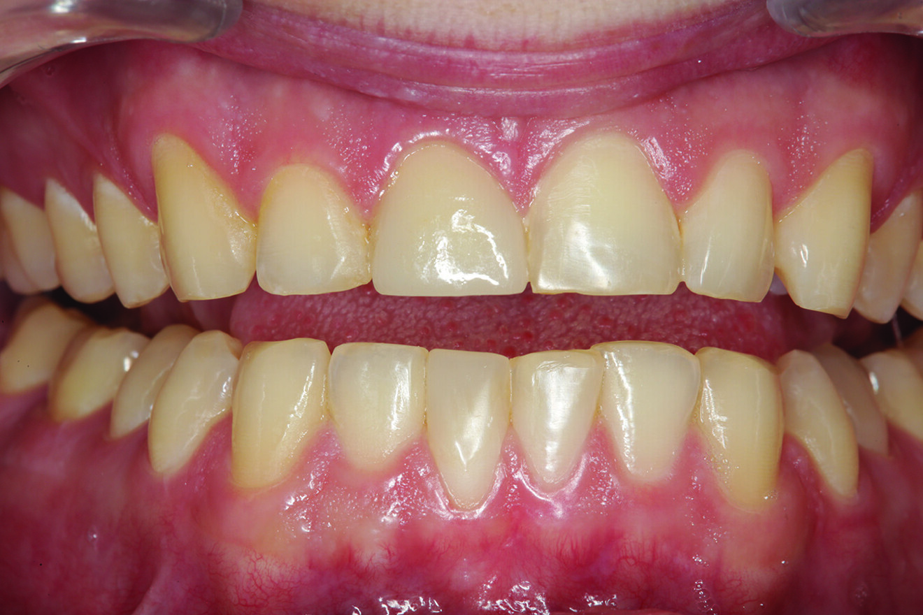 Fig. 15: Retracted facial view of the ceramic crown on tooth #11 after cementation with the teeth separated.