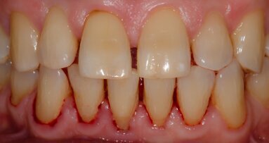 The intersection of technology: Guided implant surgery and 3D printing