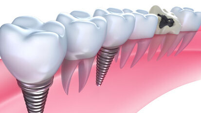 Dental implantology: Evolution or the road to ruin?