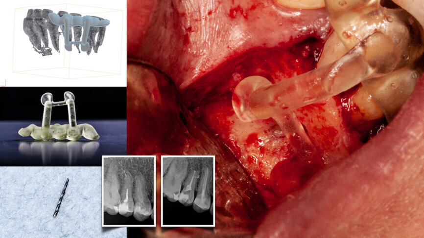 Fig. 1b: Three-dimensional stent printed for static navigation guidance to facilitate removal of an instrument in the periapex. Stents are cumbersome, bulky and restrictive in posterior regions. Once planned, the osteotomy path cannot be altered. (Courtesy of Dr Hugo Sousa Dias)