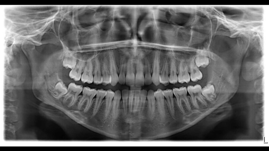Fig. 2 - Ortopantomografia a inizio trattamento.