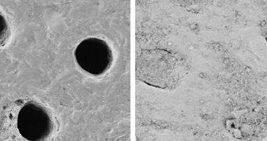 Tooth wear and new technology to manage dentin hypersensitivity