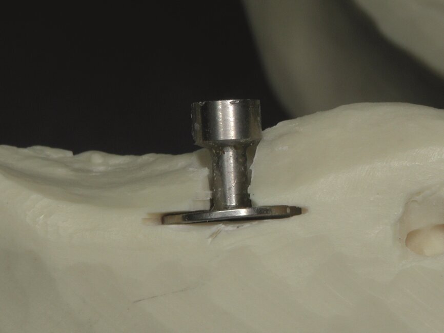 Fig. 1 : Diskimplant de 9 mm de diamètre.