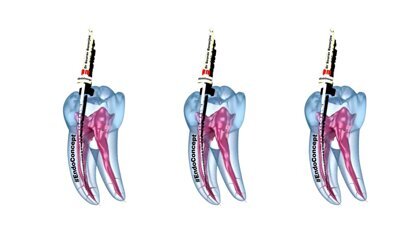 CHF technique prevents common endodontic mishaps