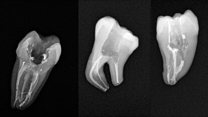 Less-Prep Endo—is a paradigm shift in root canal preparation ahead of us?