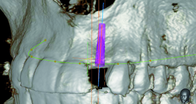 Lateral maxillary incisor implant – Key issues for aesthetic success