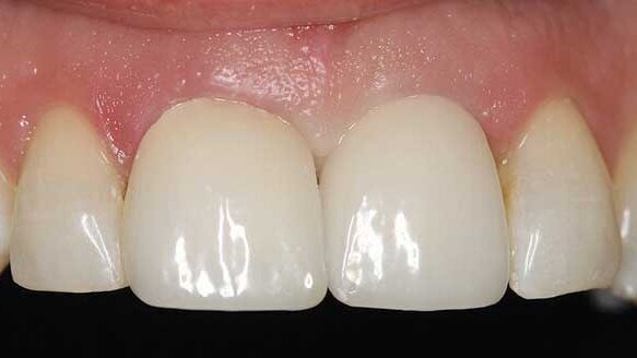 Controlling tissue contours with a prosthetically driven approach to implant dentistry