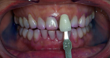 Nuove tecnologie cosmetiche di sbiancamento per il mantenimento di un sorriso estetico