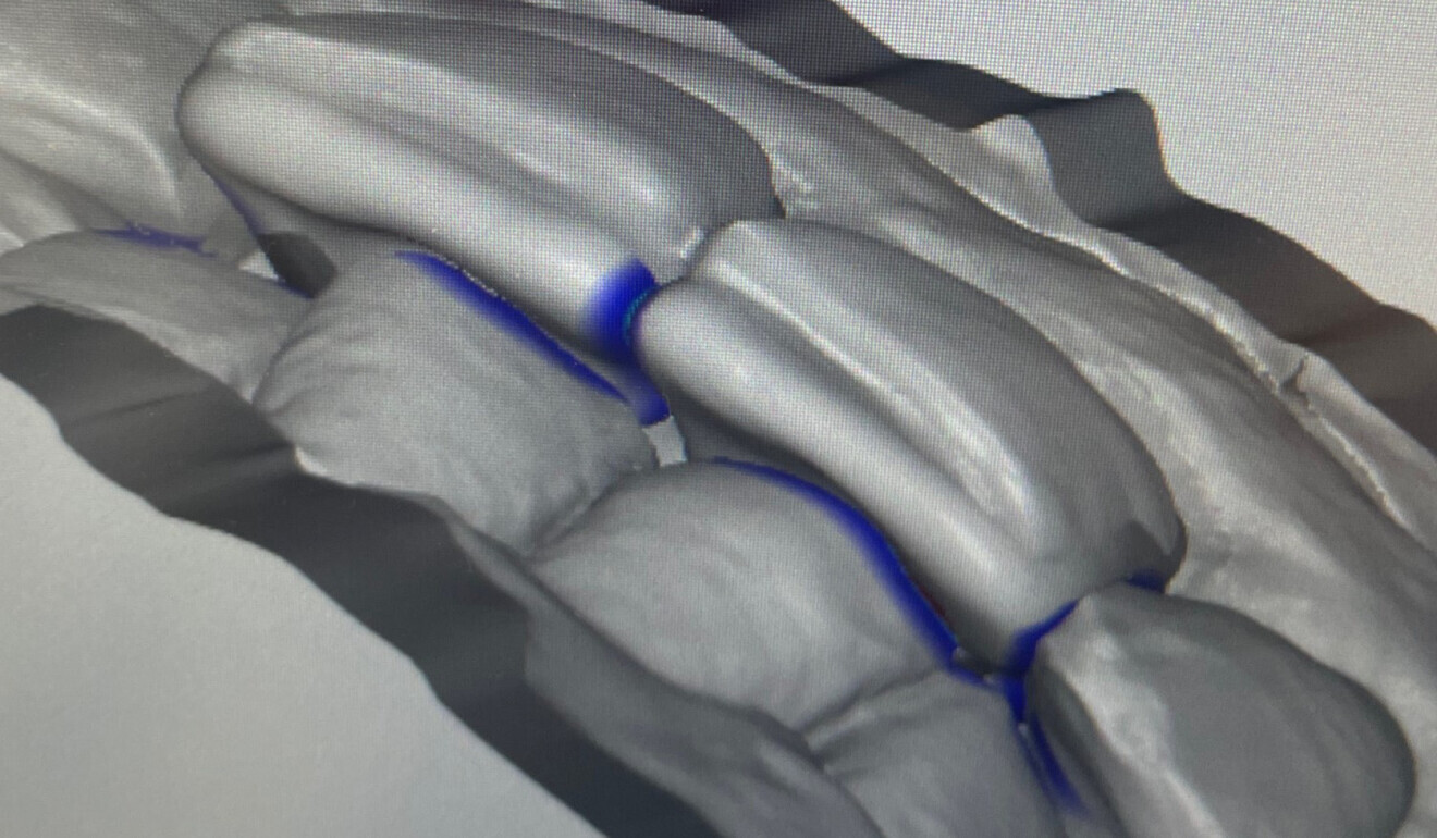 Fig. 4: Virtual models of the patient’s teeth with the newly designed crowns, revealing the space available for a slight retraction.