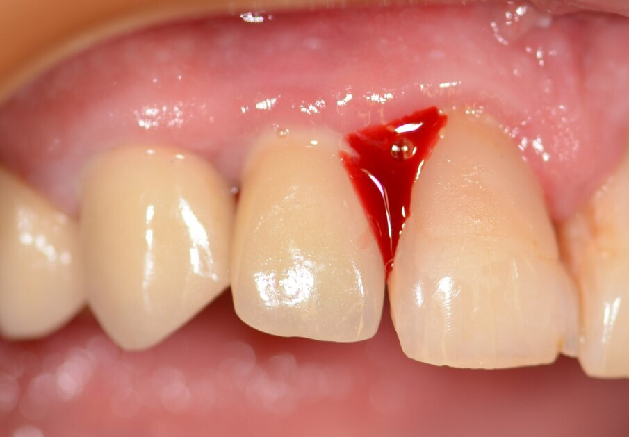 Fig. 3: Bleeding on probing.