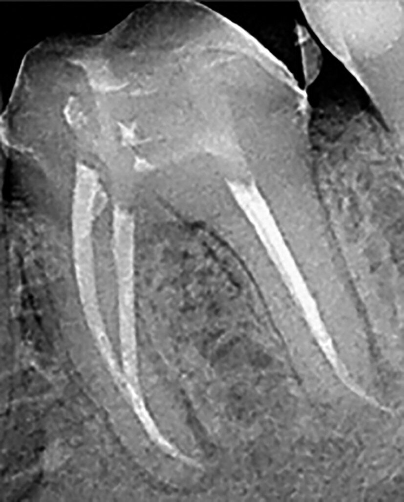 Figs. 4a et b : Cavités d’accès réalisées dans une molaire préparée pour une couronne et requérant un traitement canalaire (à gauche). Radiographie postopératoire (à droite) montrant le résultat admirable de la mise en forme du canal radiculaire, du nettoyage et de l’obturation – malgré la dimension minimale de l’orifice d’accès. À noter le plafond de la cavité pulpaire qui subsiste largement. (Photos : fournies par le Dr Steve Baerg) 