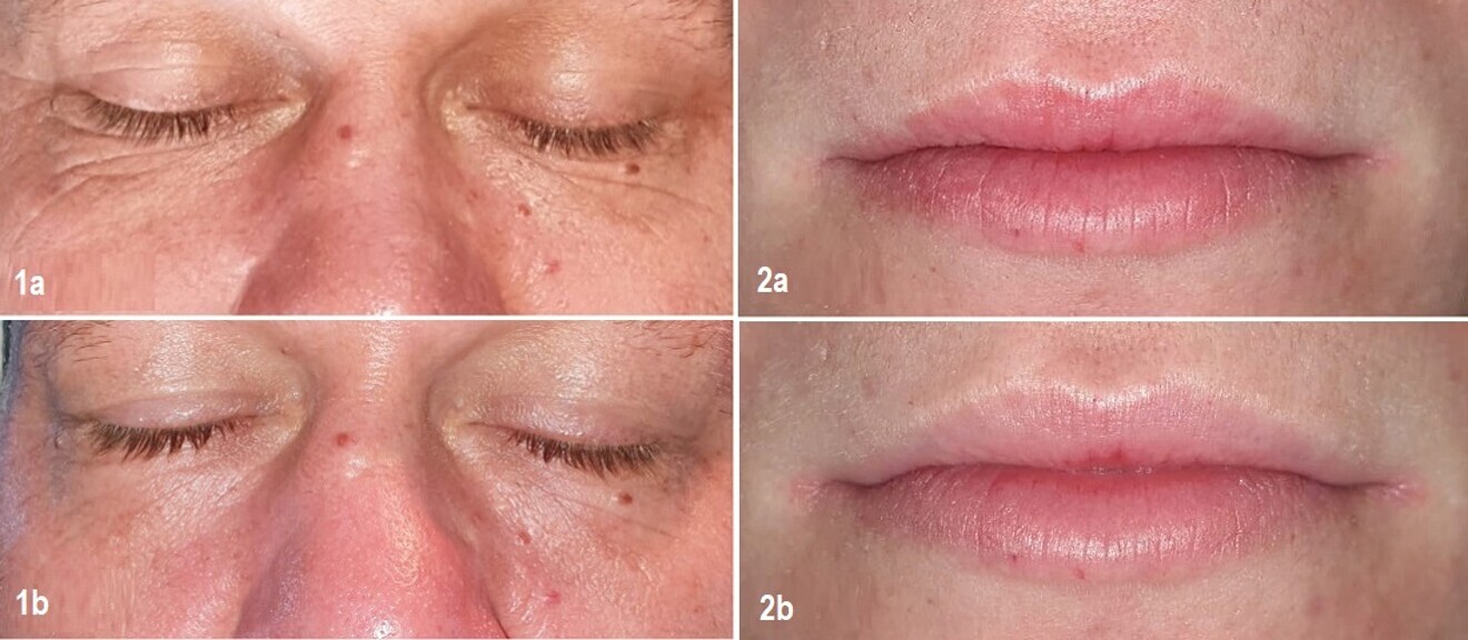 Figs.1a & b: Clinical situation before (a) and after SmoothEye laser treatment (b). Figs. 2a & b: Clinical situation before (a) and after LipLase laser treatment (b). (Images: Jolanda Grayling)