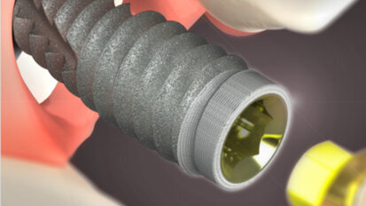 BioHorizons grants gift to NYU Dentistry to expand access, education for implant dentistry