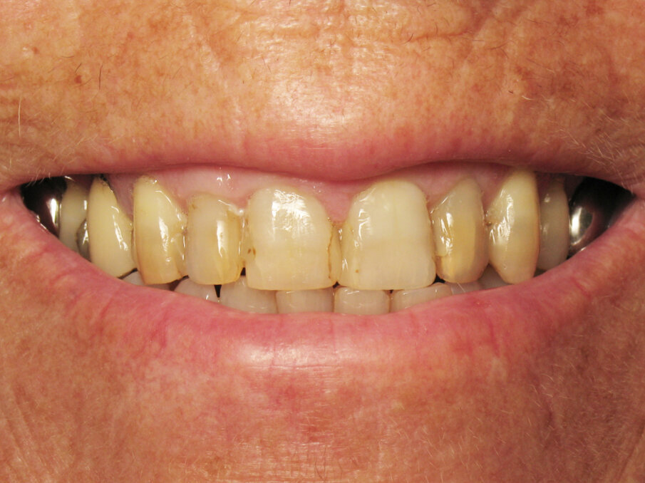 Fig. 1: Initial situation, smiling.