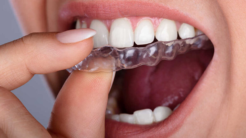 Associação Dentária Americana manifesta preocupação com alinhadores faça-você-mesmo