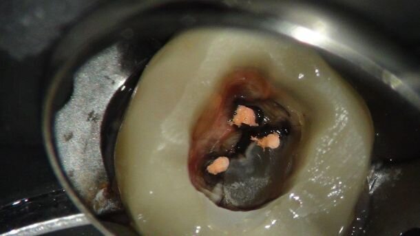 De endodontische obturatie