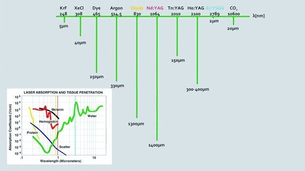 Utilisation clinique du laser Er,Cr:YSGG dans le traitement endodontique