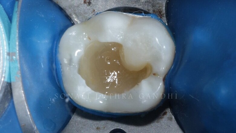 Fig 9: Cuspal Build up Technique – Mesio-buccal cusp