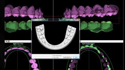 Systemy CAD/CAM w zabiegach korekcyjnych szczęk w chirurgii ortognatycznej