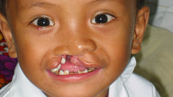 Times of crisis bring new plans for craniofacial medical care