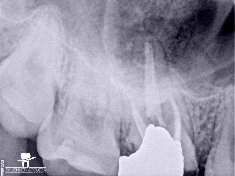 Fig. 2: Periapical radiograph of the maxillary right molar. Tooth #18 was to be transplanted to the site occupied by tooth #16.