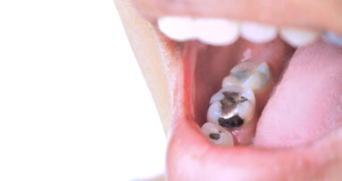 COP6 confirms 2034 amalgam phase-out with key clinical exemption