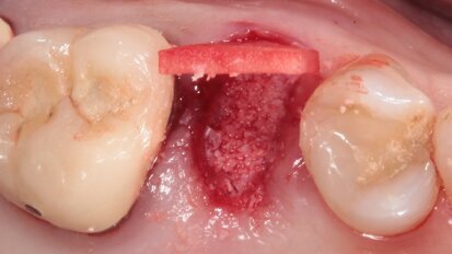 Socket preservation con acido ialuronico reticolato e riabilitazione impianto supportata di un secondo premolare superiore