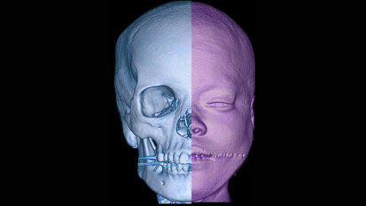 Pak Maxillofacial Surgeons Await International Recognition