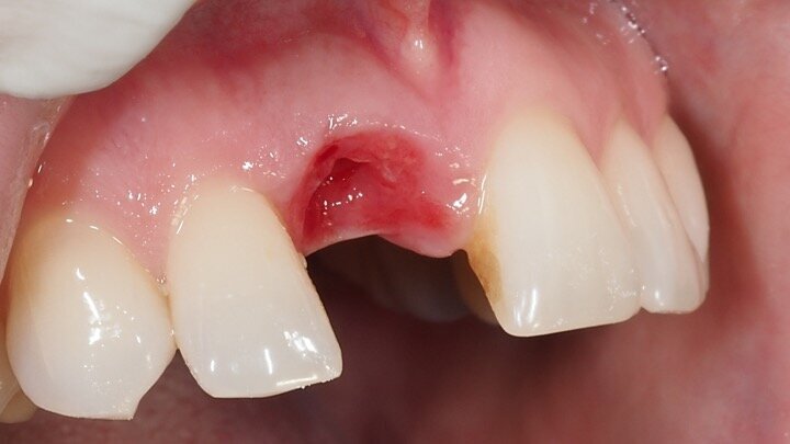 Figura 18. Imagen a los 3 meses al retirar la corona provisional. Obsérvese el grosor del margen gingival debido al uso del pilar cóncavo y la presencia de algunas partículas de biomaterial dentro del tejido blando. Estas partículas realizan una fibrointegración en el tejido conectivo que produce la estabilidad de estos tejidos durante años.