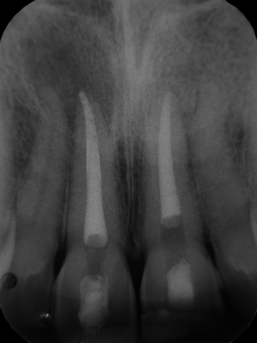 Fig. 6: Post-operative radiograph.