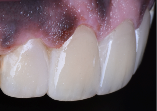Step 7 – Finishing & Polishing   Finishing was completed using (Enhance® Finishing System) and then the polishing procedure was completed using (Enhance® PoGo system and Prisma Gloss® pastes).