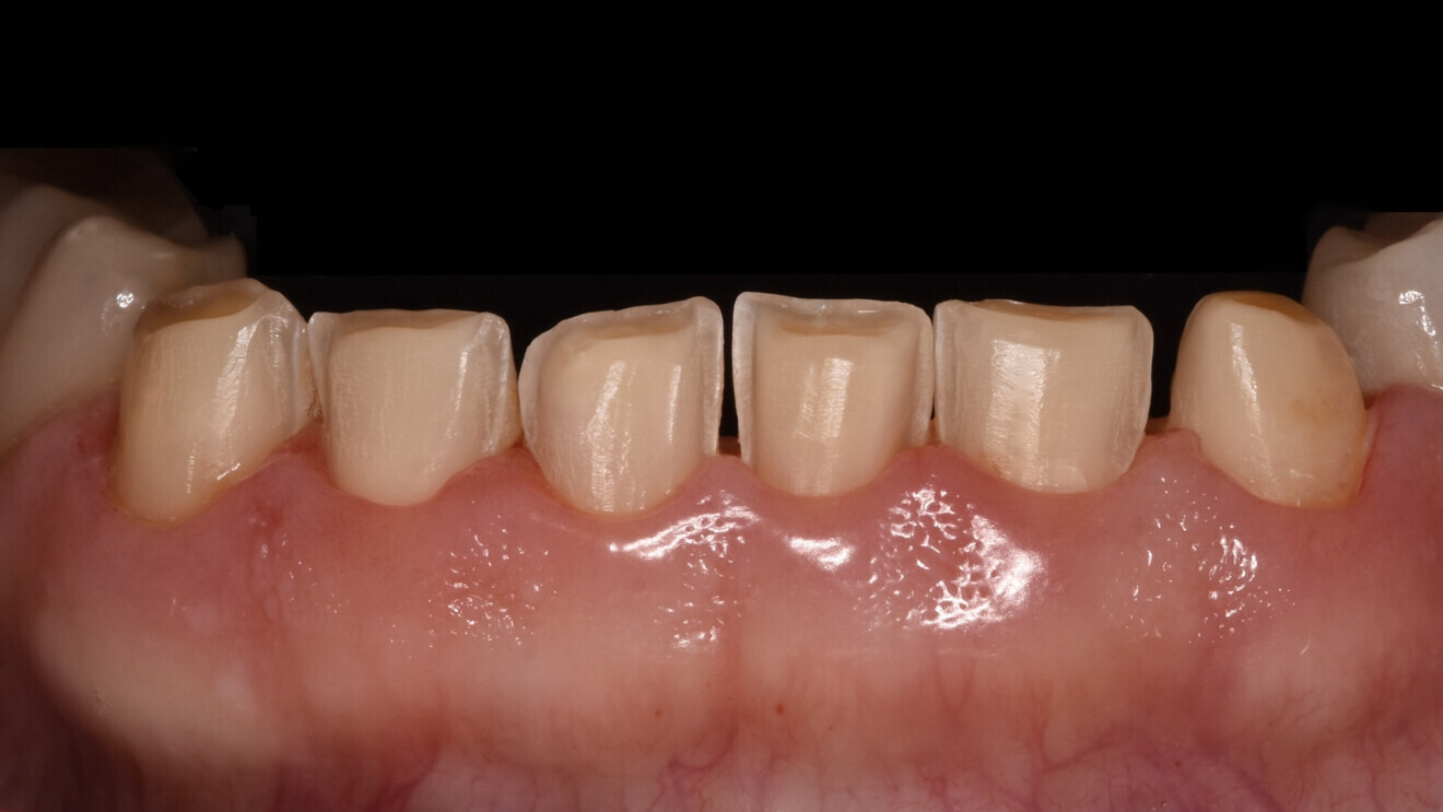 Fig. 12: Veneer preparation of the mandibular anterior teeth.
