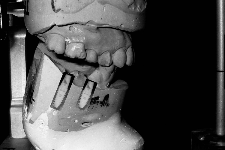 Fig. 1: Implant treatment planning