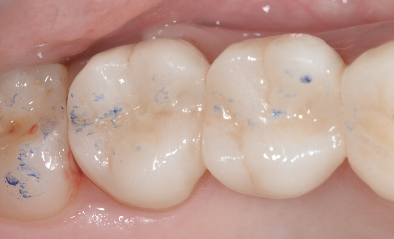 Fig. 6: Post-op view. 