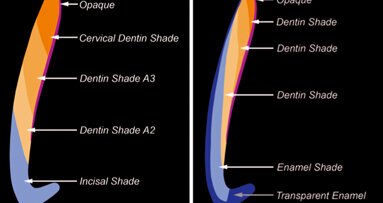 Shading technique in direct aesthetic restorations