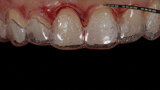 Figs. 6a y 6b. Ajuste intraoral de la guía quirúrgica para alargamiento de coronas.