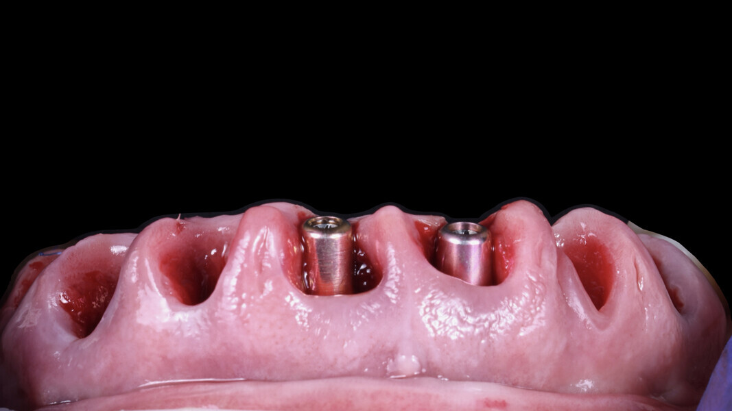 Fig. 18: After extraction of the rest of the teeth and placement of healing abutments on the implants.