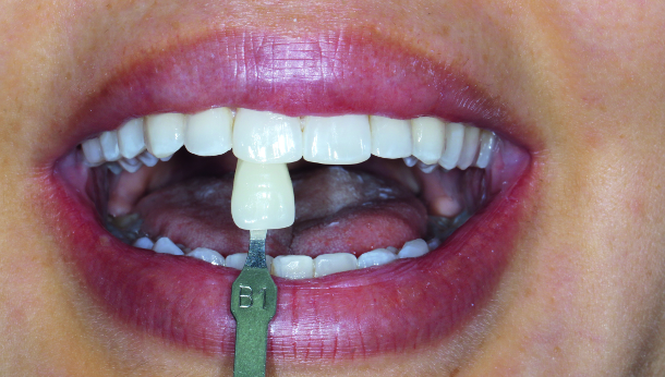 Fig. 5: Final result, after bleaching and remineralisation with nHAp by PrevDent.