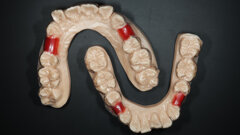 In-house 3D-printing workflows for implant restorations and Shape Memory Aligners