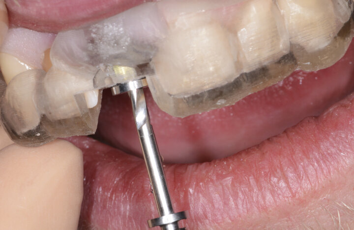Fig. 14: A sequence of implant drills with specific guide sleeves were used.