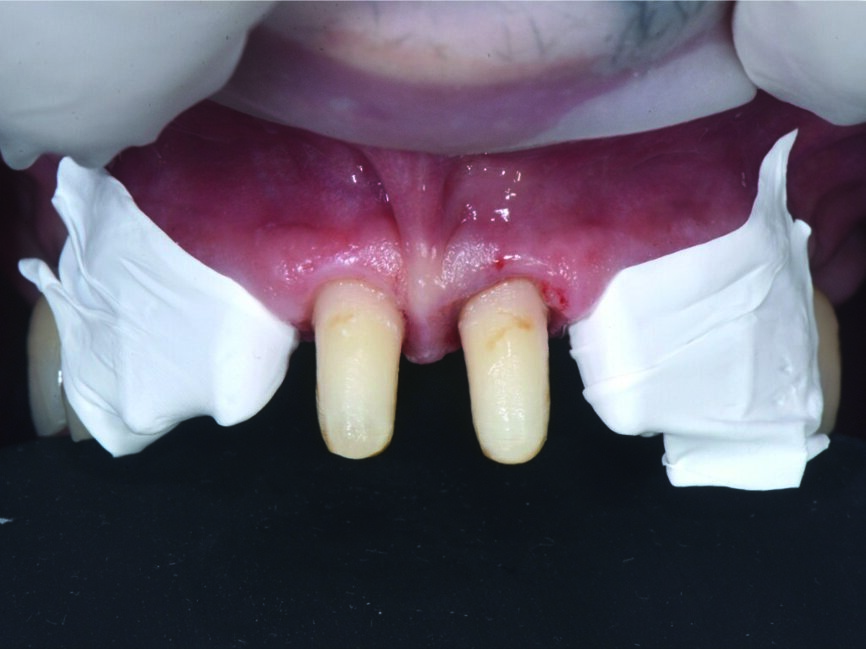 Fig. 9 : Scellement 