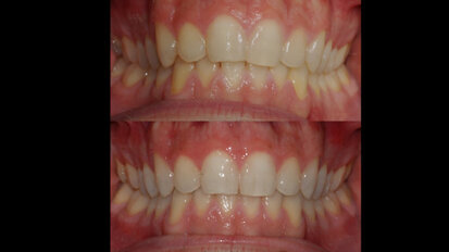 Valutazione clinica dello sbiancamento combinato post Invisalign: case report