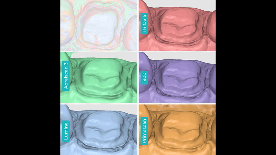 Fig. 11 - Immagini ravvicinate delle scansioni di preparazione del dente e delle relative maglie tassellate. TRIOS 5 (a). Aoralscan 3 (b). Medit i900 (c). ITero Lumina (d). CEREC Primescan (e).