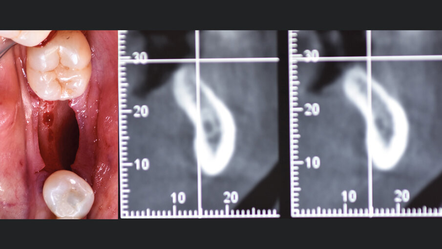 Fig. 2 - A sinistra: lembo aperto si evidenzia la carenza di volume orizzontale. A destra: CBCT pre-operatoria che mostra l’entità del difetto.
